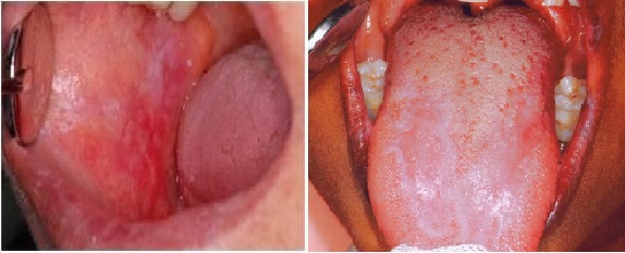 Lichen planus a sz j regben OLP Oral lichen planus ENT House